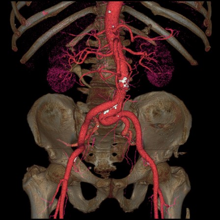 Aorte, janv. 2015 Aorte